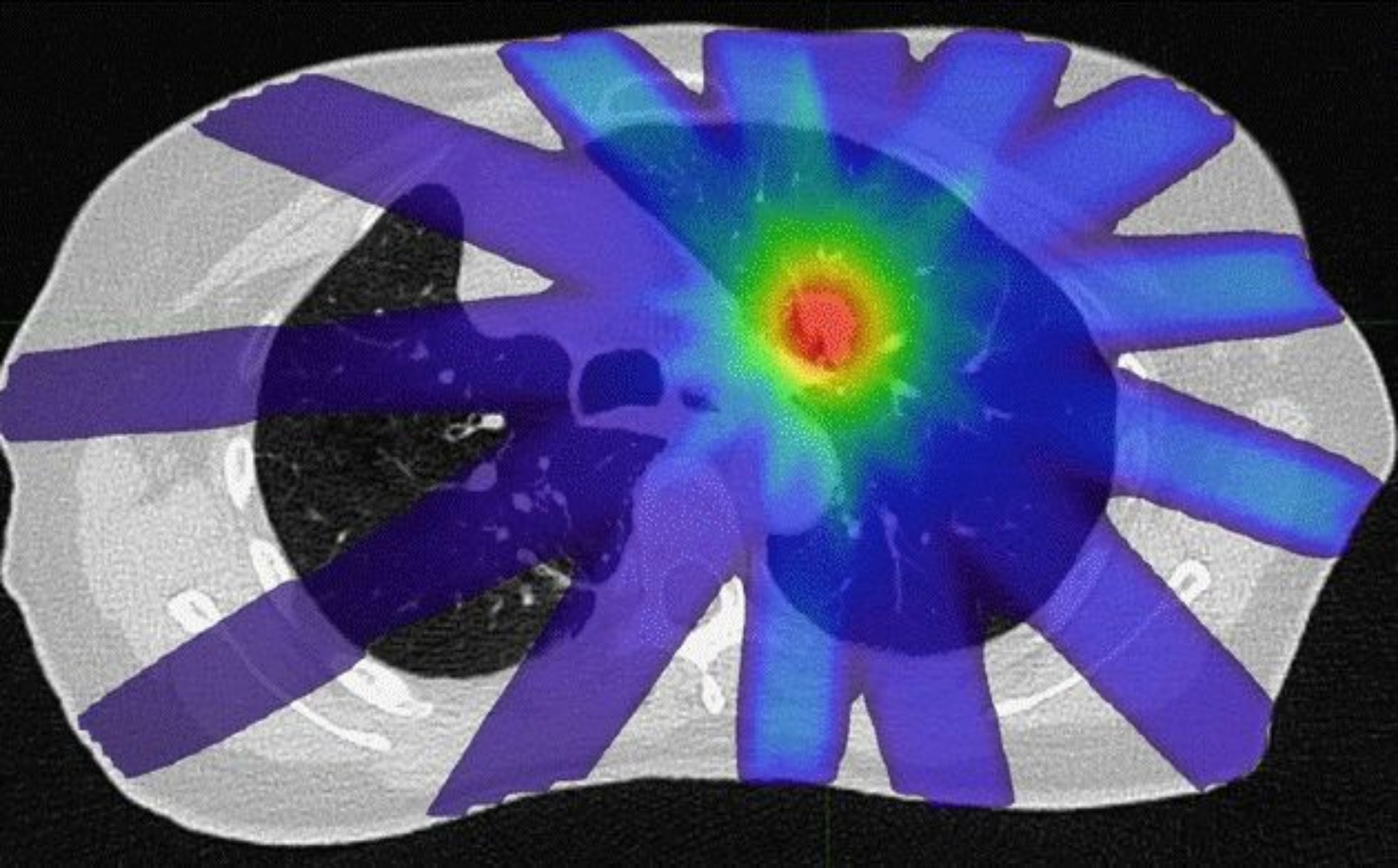 Oligometastatic Disease Program